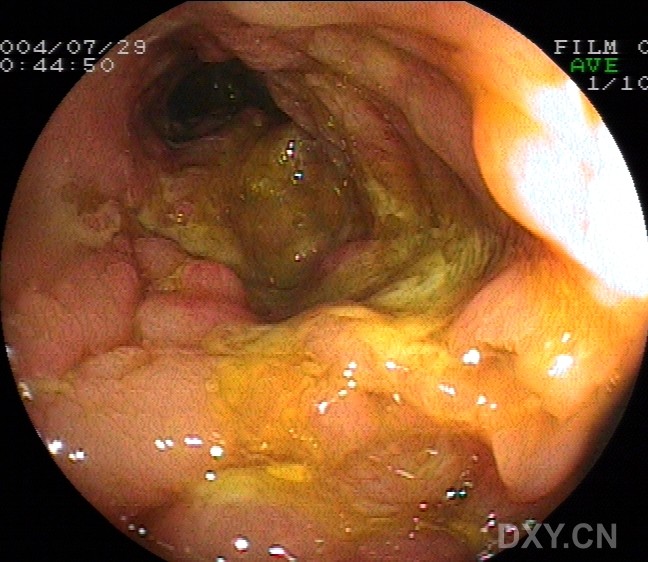 克罗恩病 ct_罗克恩病严重吗_罗克恩病怎么确诊