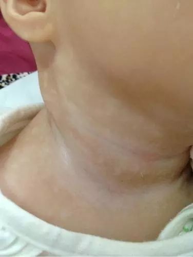 小孩咳嗽哮喘症状有哪些_小孩咳嗽哮喘_小孩咳嗽哮喘症状