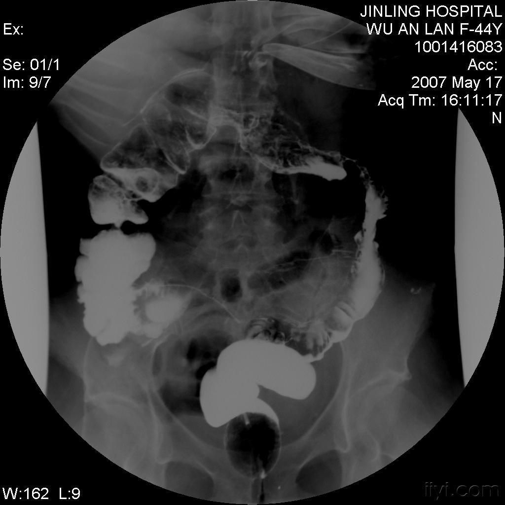 课罗恩病_粘肿型地克病_克罗恩病(cd)