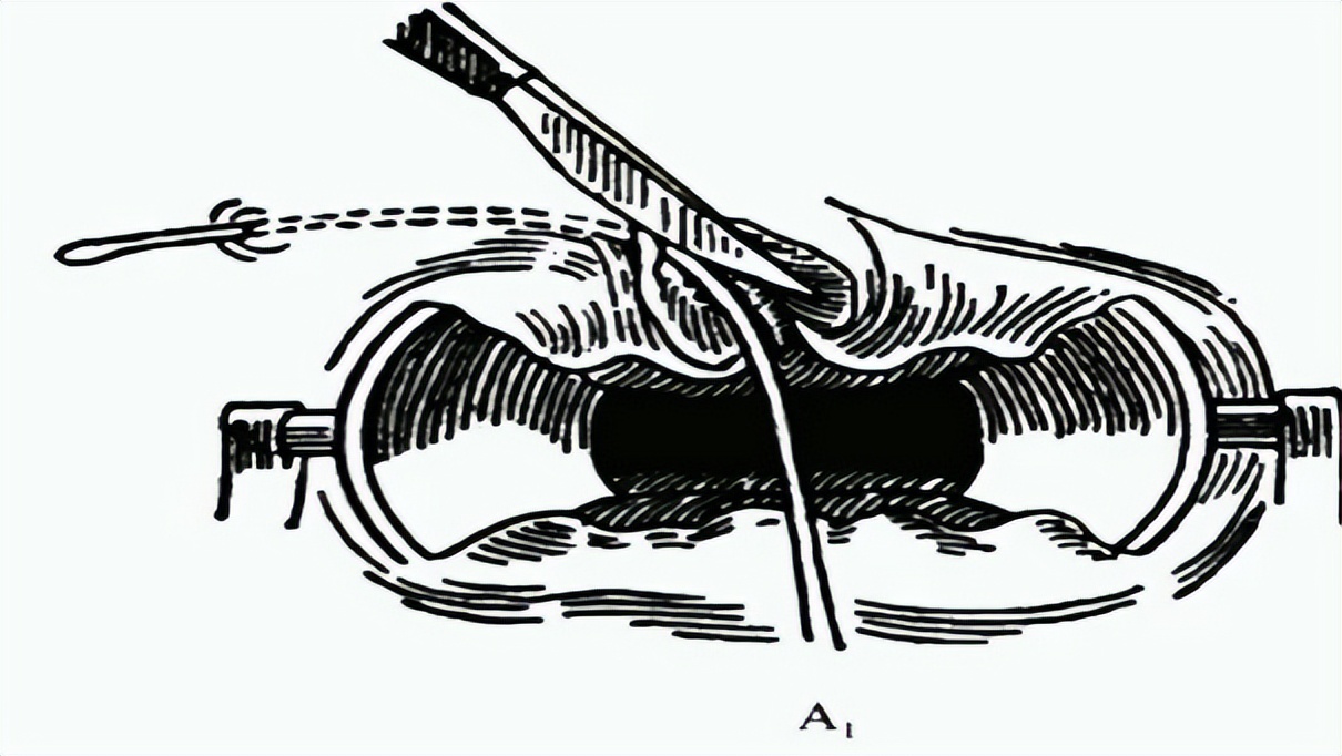 肛瘘手术后多长时间恢复_多长手术恢复肛瘘时间后会复发_肛瘘手术后多长时间会复发