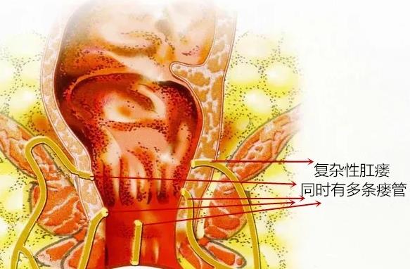 低位肛瘘手术伤口愈合需要多长时间_低位肛瘘伤口愈合过程_低位肛瘘伤口多深