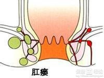 伤口手术能长好肛瘘时间吗_肛瘘手术后伤口什么时间能长好_伤口手术能长好肛瘘时间多久