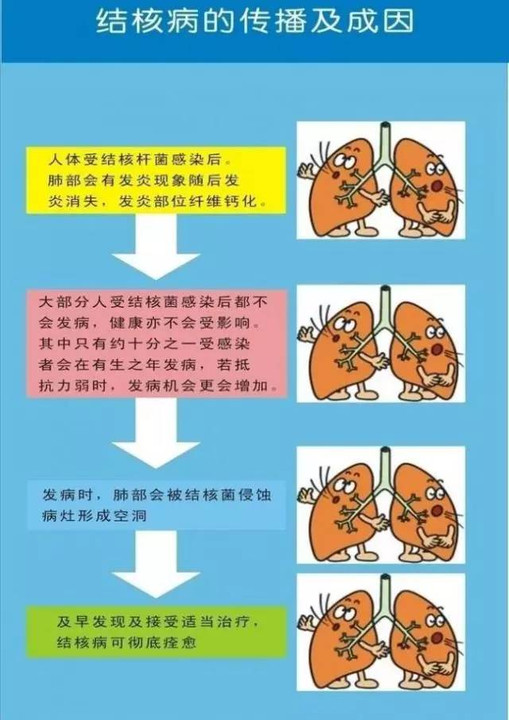 三型肺结核症状有哪些_肺结核的型状_肺症状结核型有哪些