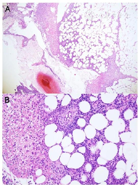 克罗恩怎么确诊_罗克恩病怎么确诊_罗恩克病