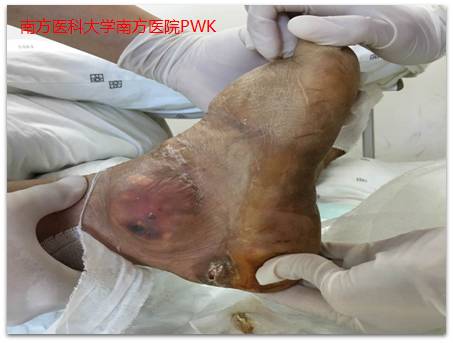 肛门失禁的症状 治疗_肛门症状治疗失禁的药物_肛门失禁的治疗