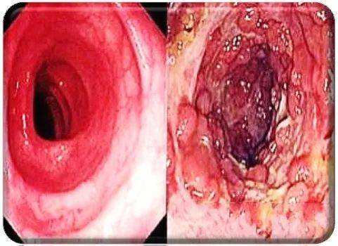 克罗恩病关节炎治疗_克罗恩关节炎_克罗恩病关节炎
