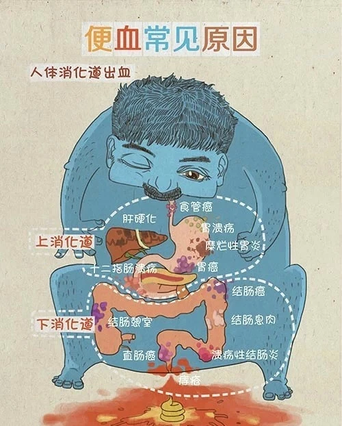 大便出血是怎么回事呢_出血大便回事是怎么回事_出血后大便什么病