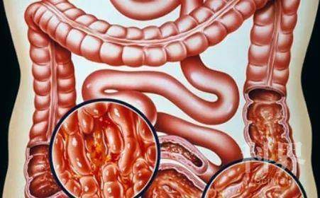 克罗恩病线样征x图片_克罗恩病线样征x图片_克罗恩病线样征x图片