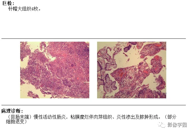 克罗恩病的鉴别诊断_诊断克罗恩病的检查首选的是_克罗恩诊断与鉴别诊断