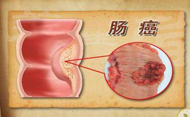 大便出血是怎么回事呢_出血大便_出血后大便什么病