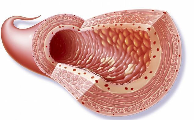 克罗恩病线样征x图片_克罗恩病线样征x图片_克罗恩病线样征x图片