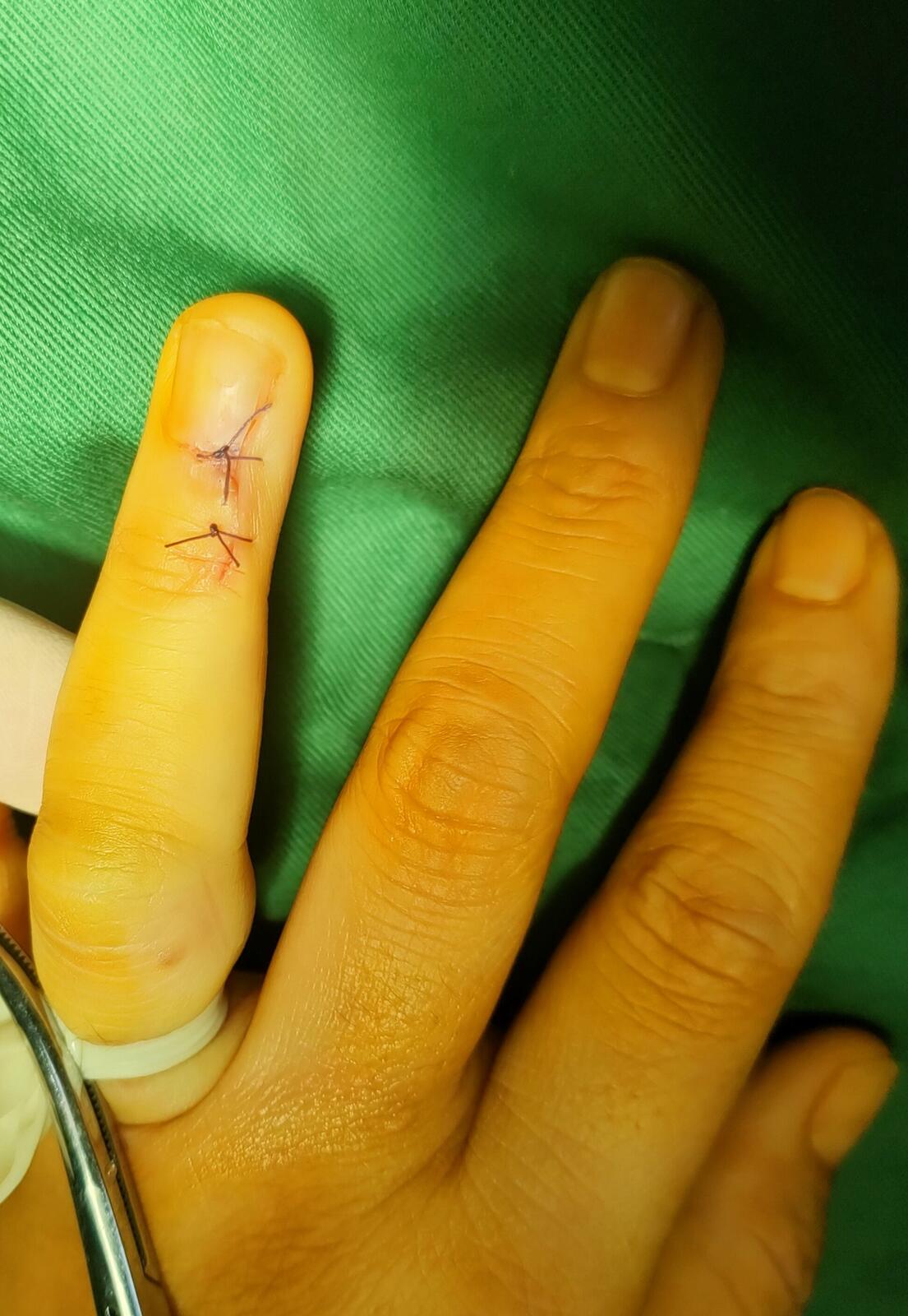 恒瑞免疫治疗血管瘤_恒瑞 pd 1 血管瘤_恒瑞pd-1血管瘤