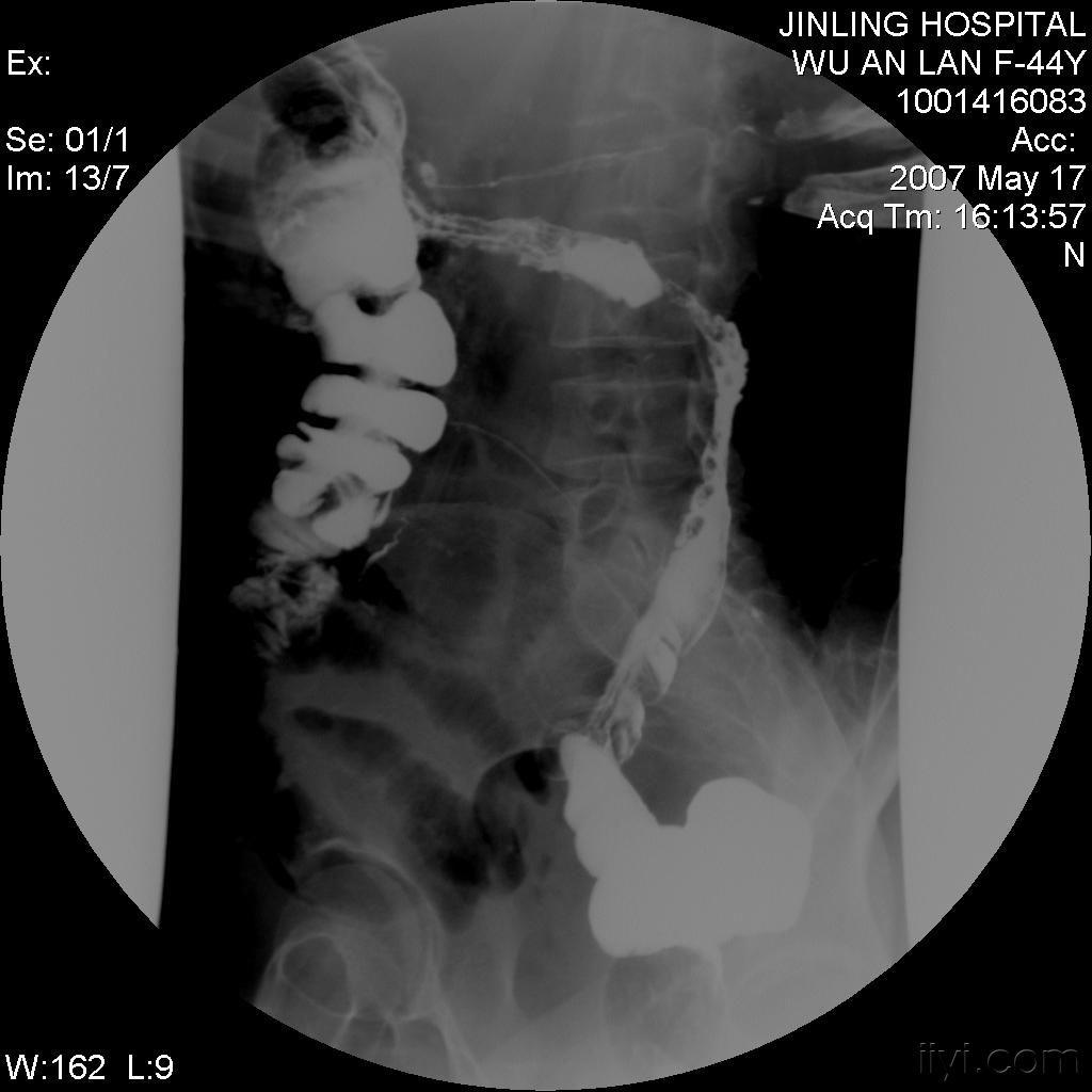 课罗恩病_粘肿型地克病_克罗恩病(cd)