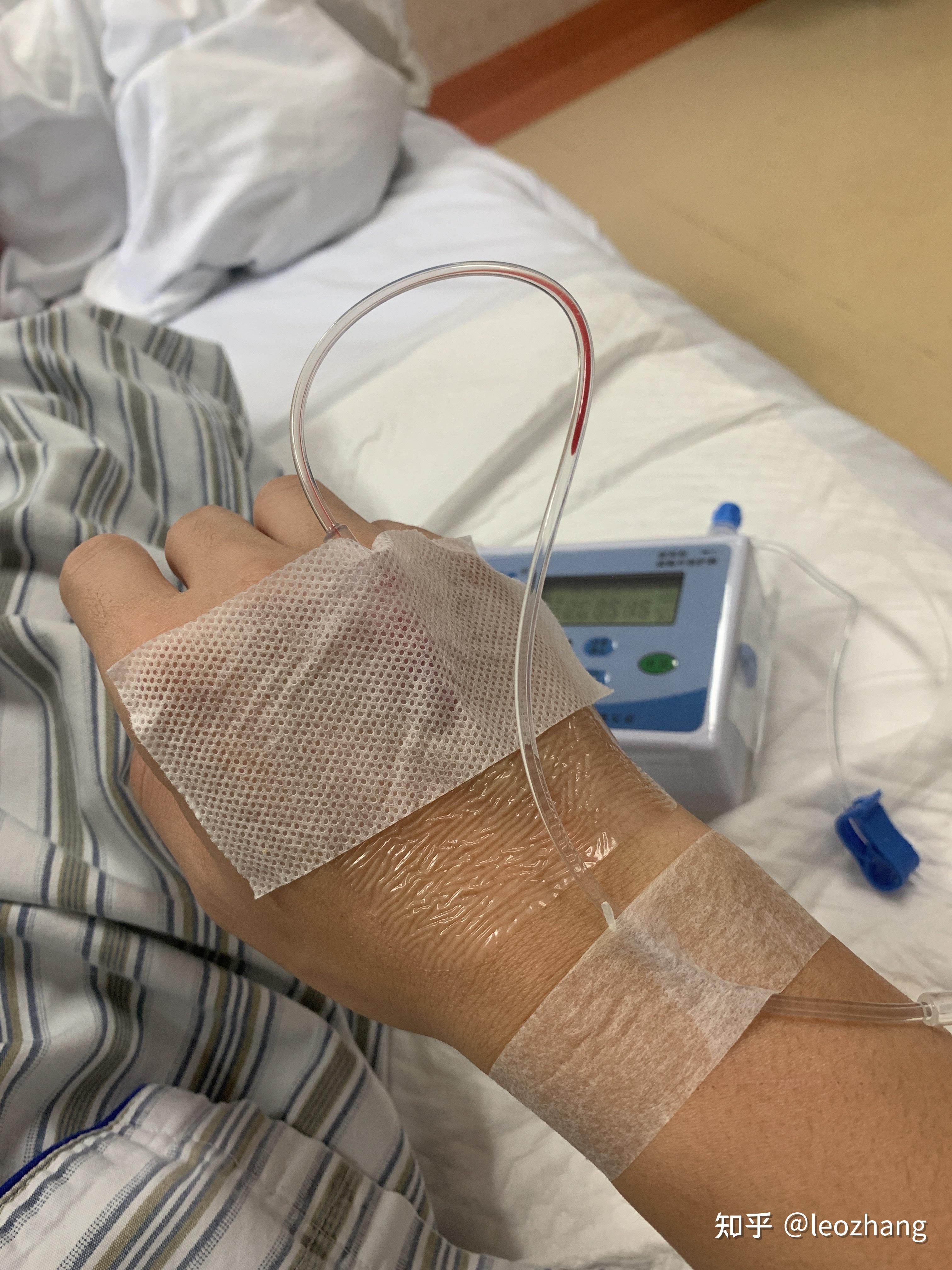 多长手术恢复肛瘘时间后会复发_肛瘘手术后多长时间会复发_肛瘘手术后多长时间恢复