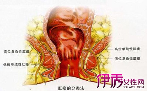 手术恢复肛瘘时间多久_肛瘘手术恢复时间_肛瘘手术恢复好了啥样子