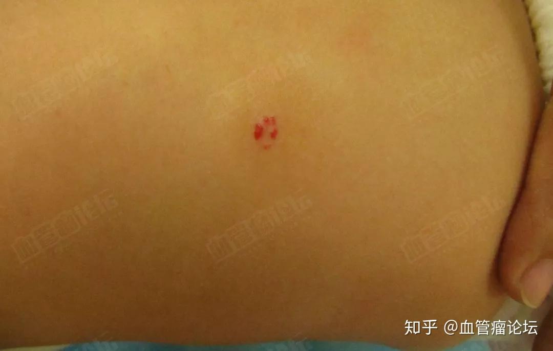 恒瑞pd-1血管瘤_恒瑞免疫治疗血管瘤_恒瑞 pd 1 血管瘤