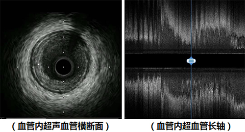 冠心病患者药物治疗_冠心病治疗药物_冠心病的药物治疗原则是什么