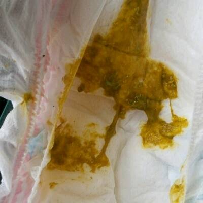 克罗恩病都有哪些症状_罗克恩病早期症状_罗克恩病严重吗