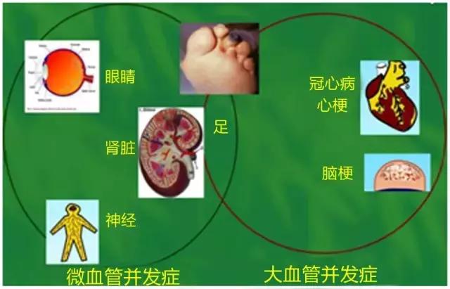 护理合并冠心病病糖尿病治疗_护理合并冠心病病糖尿病患者_糖尿病合并冠心病的护理