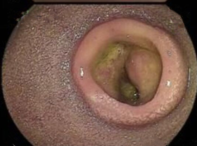 罗克恩病严重吗_罗克罗恩病的特征性体征_克罗恩病患者