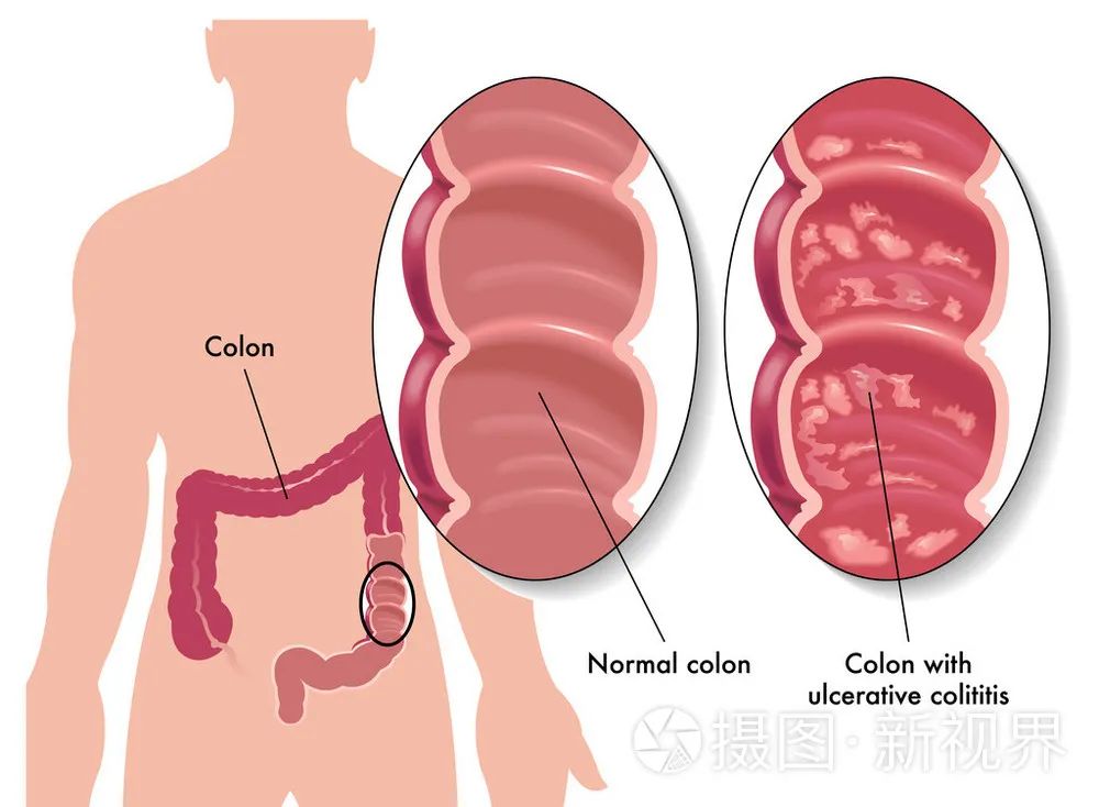 克罗恩代病_罗克恩病早期症状_罗克罗恩病
