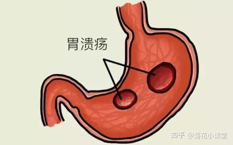 健康之路胃病专题嗳气_健康之路胃胀嗳气_健康之路嗳气代茶饮