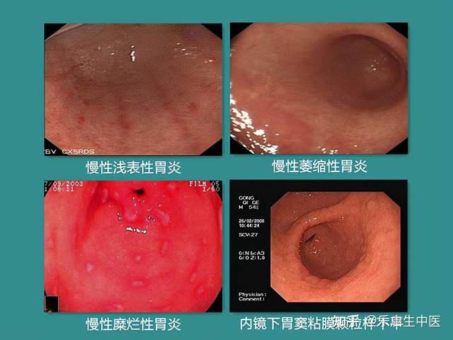 胃溃疡中医治疗_中医药治疗胃溃疡_胃中医治疗溃疡的方剂