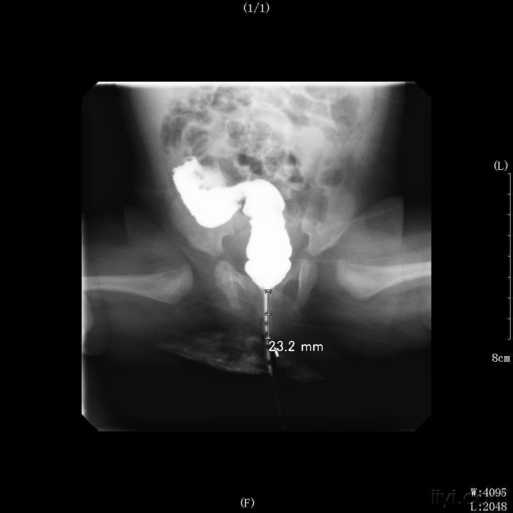 大便肛门闭锁失禁吃什么药_肛门闭锁大便失禁_大便肛门闭锁失禁怎么治疗