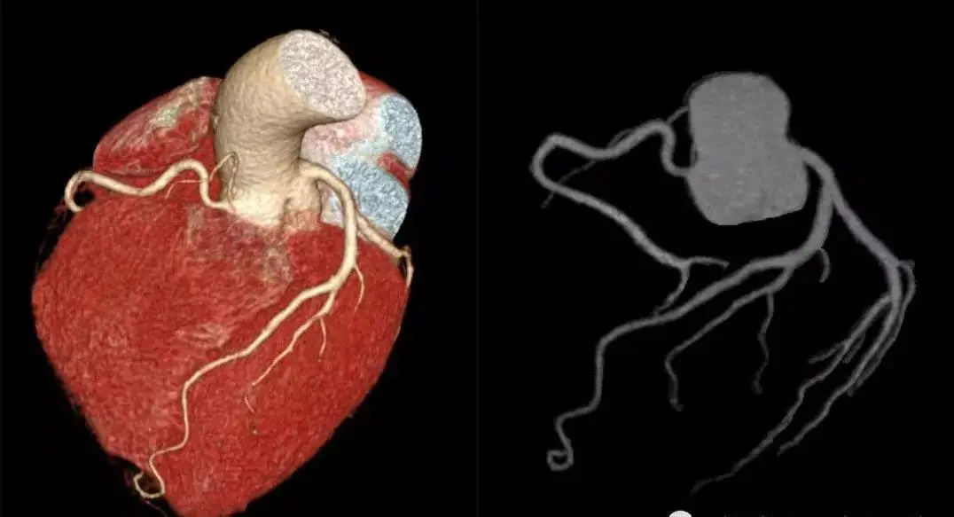 简述冠心病病人的护理措施_护理简述病人冠心病措施怎么写_护理简述病人冠心病措施及护理