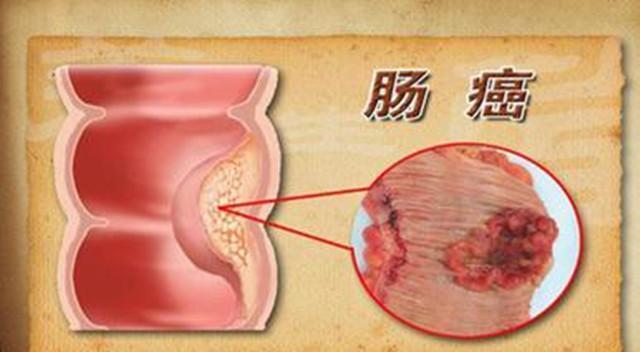 我每天大便出血是怎么回事_大便出血每天大便次数多_出血每天大便回事是怎么回事