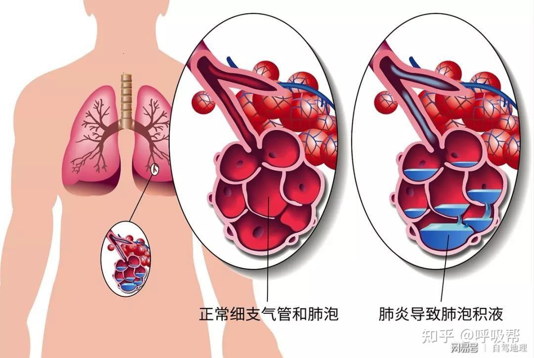 呼吸衰竭的分类方法_什么是呼吸衰竭分型_呼吸衰竭定义及分类