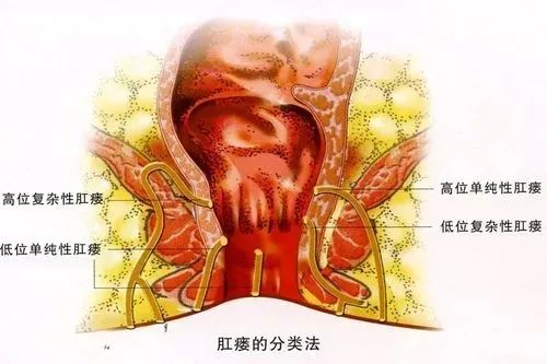 肛周脓肿手术后肛门失禁_肛周脓肿手术后会失禁吗_肛周脓肿手术后肛门轻度失禁