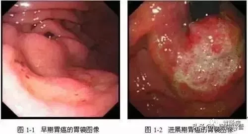 中药胃溃疡药_胃溃疡中药方_中药胃溃疡会愈合吗