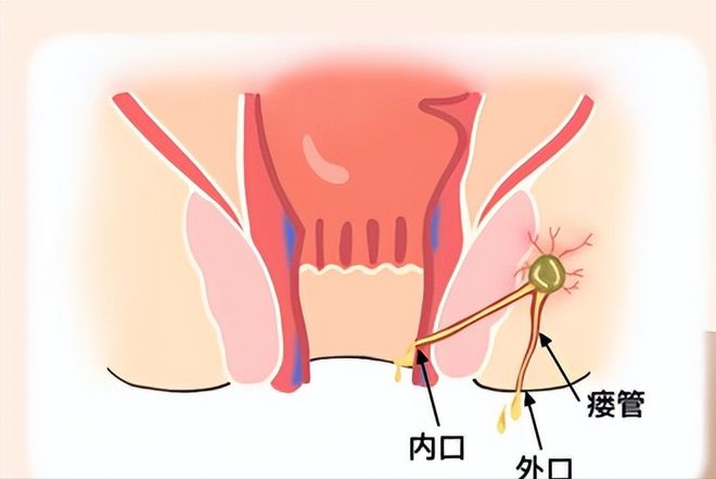 两次肛瘘手术间隔时间_肛瘘二次手术间隔时间_间隔手术次肛瘘时间多长