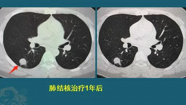 肺结核自愈性继发会复发吗_继发性肺结核会自愈吗_肺结核治愈后继发性