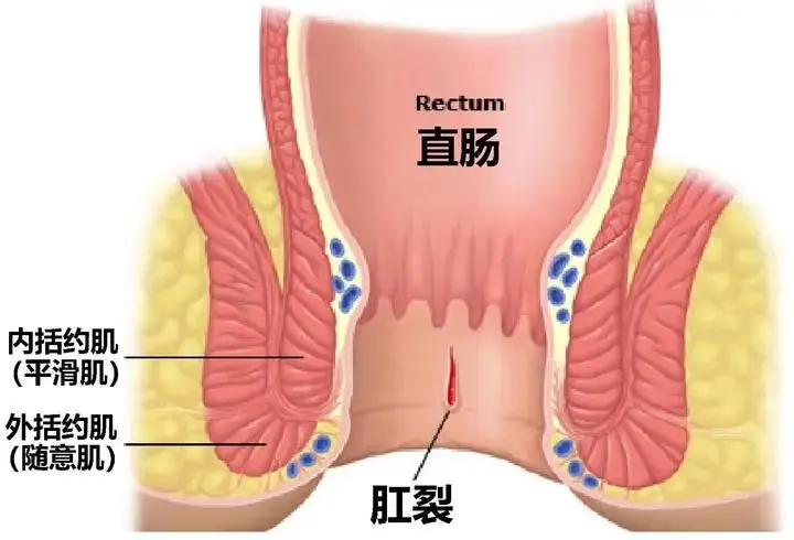 大便出血每天大便次数多_出血每天大便回事是怎么回事_我每天大便出血是怎么回事