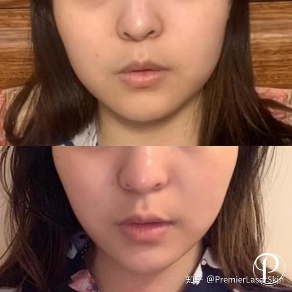 打botox瘦脸效果图对比_瘦脸针对比图真人_打瘦脸前后对比
