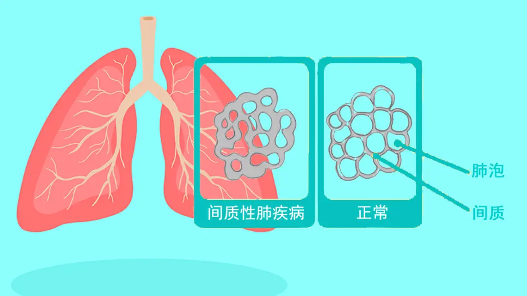 肺蛋白沉积症_肺蛋白沉积症会自愈吗_蛋白症肺沉积怎么治疗