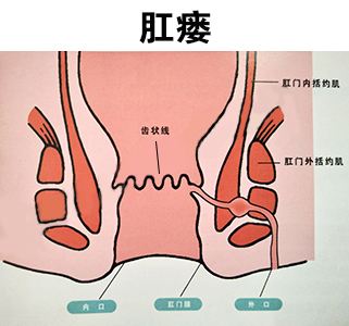 肛瘘手术前多长时间备皮灌肠_肛瘘术前灌肠后多久可以拉完_肛瘘术前灌肠怎么灌