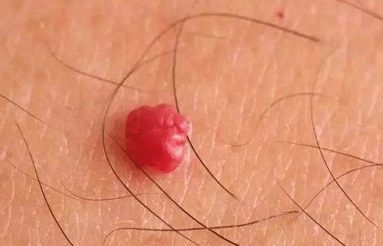 前胸后背疼有红痣_前胸后背都有红痣_胸前后背有红痣代表什么
