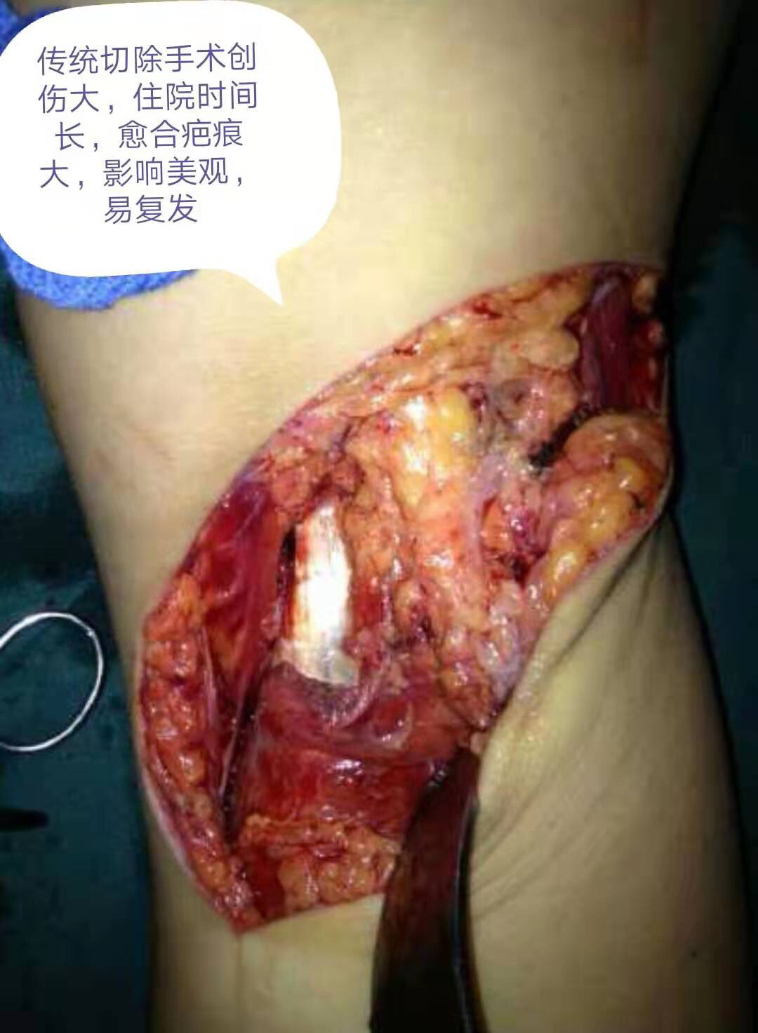 手术恢复肛瘘时间多长_肛瘘手术恢复时间_肛瘘手术后修复手术