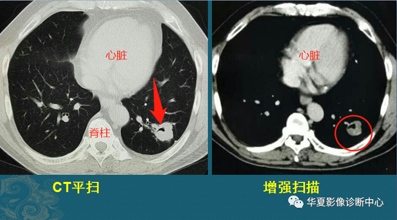 空洞肺结核要吃多久药_空洞型肺结核食补_空洞型肺结核吃啥最好