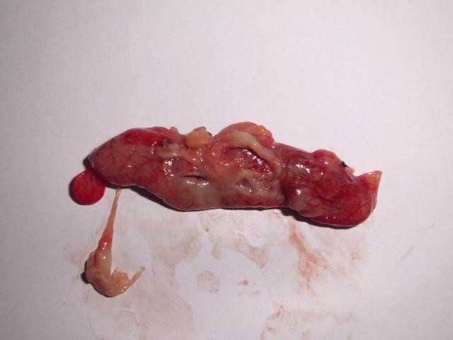 阑尾炎开刀_阑尾炎开刀后对身体有影响吗_阑尾炎开刀后有什么后遗症