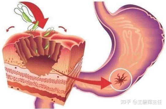 中医治疗胃溃疡_胃中医治疗溃疡的方子_中医治疗胃溃疡的效果
