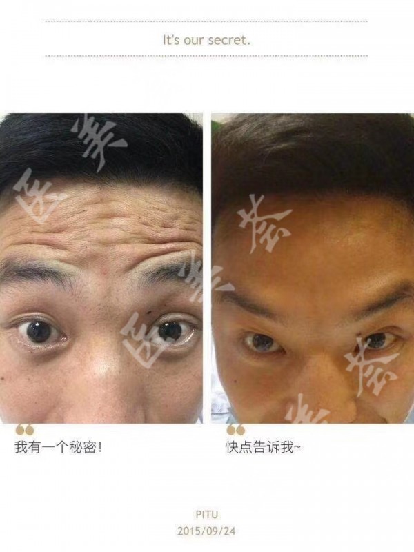 打botox瘦脸效果图对比_瘦脸针对比图真人_瘦脸针对比照