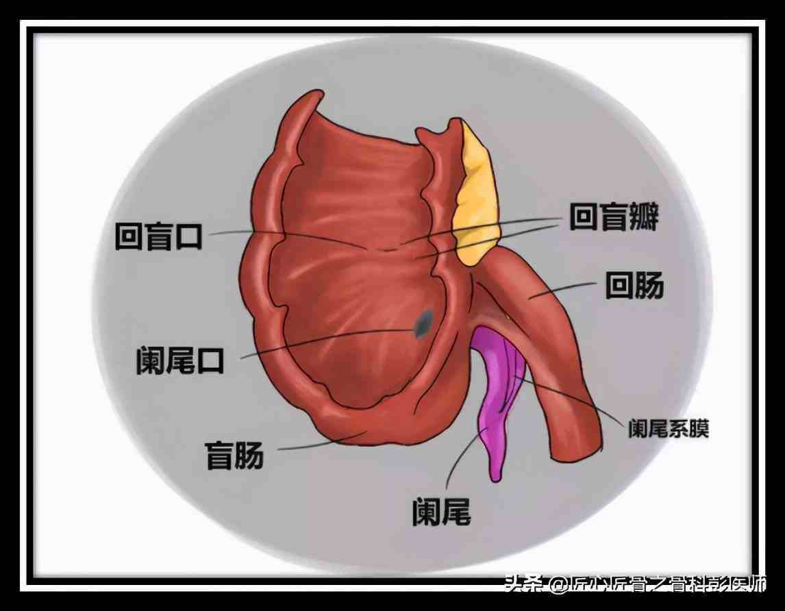 急性阑尾炎术后护理要点是什么_急性阑尾炎术后5个护理问题_急性阑尾炎手术后的护理