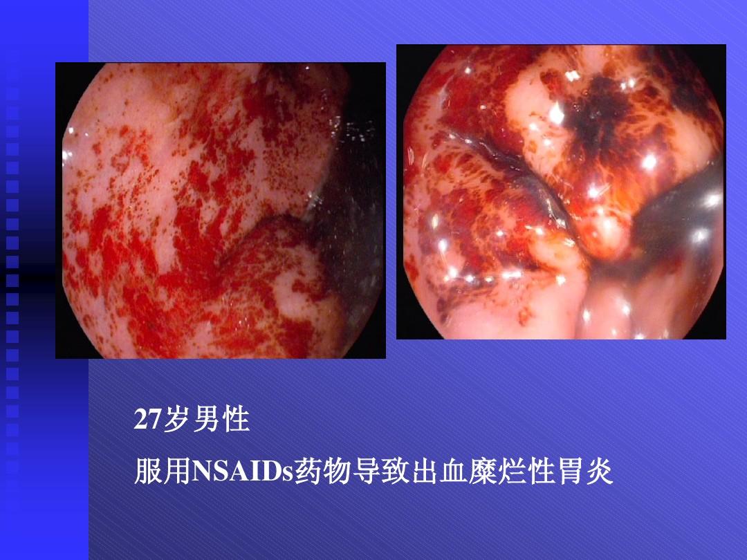 拉屎拉出血来_出血拉屎出血_出血拉屎拉来就没有了