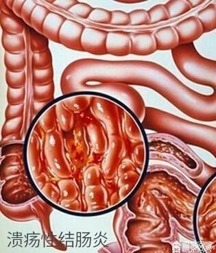 老年人大便出血是怎么回事_老人大便大出血_65岁大便出血