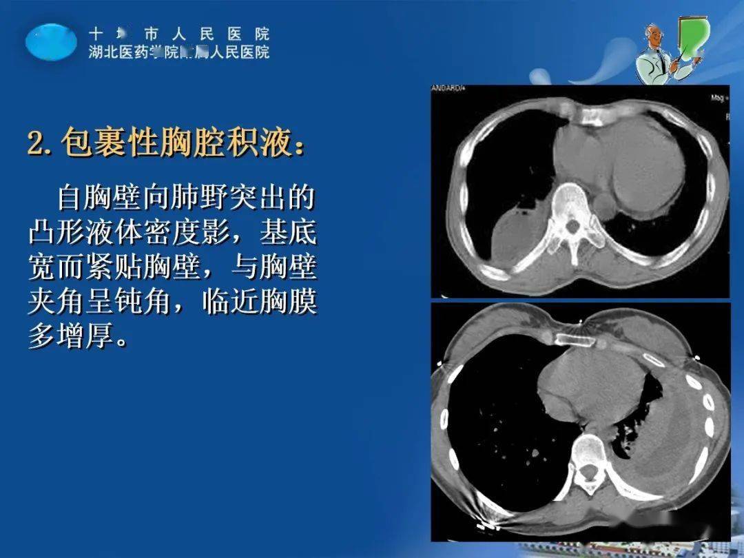 消化道穿孔典型ct图片_消化道穿孔的x线图片_消化道穿孔ct图片