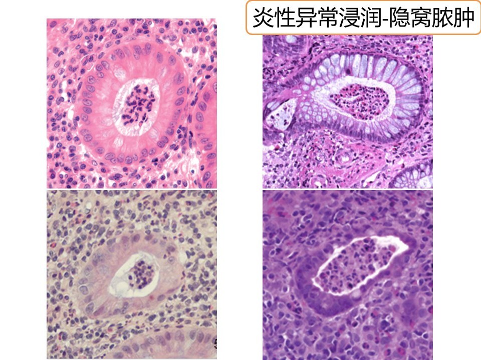 肠化生真的有那么可怕吗_肠化生的概念_肠化生论坛